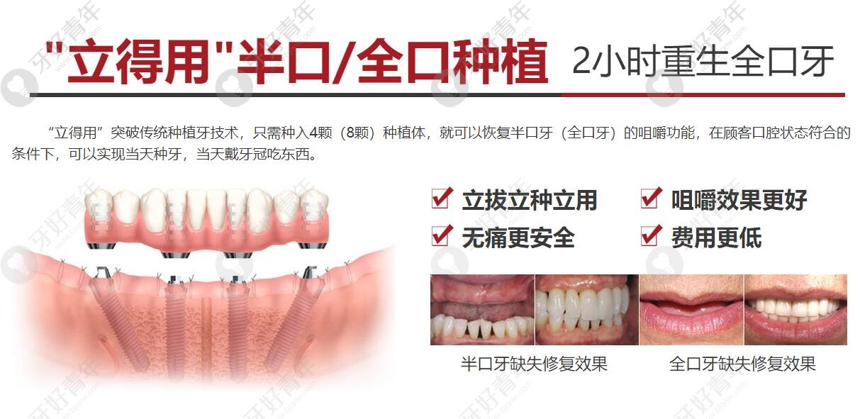 北京中诺口腔立得用种植牙