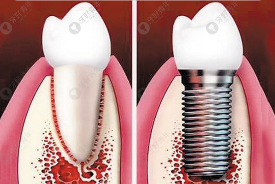 韩国Dentis登特斯种植牙系统