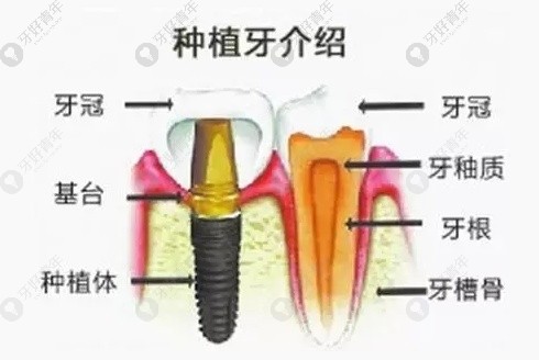 种植牙的结构分布