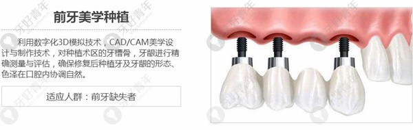 上海圣贝口腔前牙美学种植技术