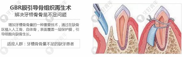 圣贝口腔GBR膜引导骨组织再生术