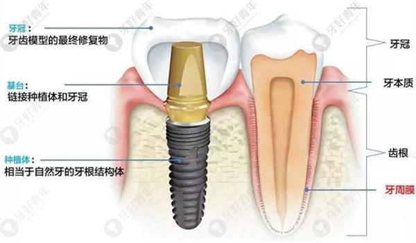 在深圳南山区牙科医院种了两颗德国种植牙