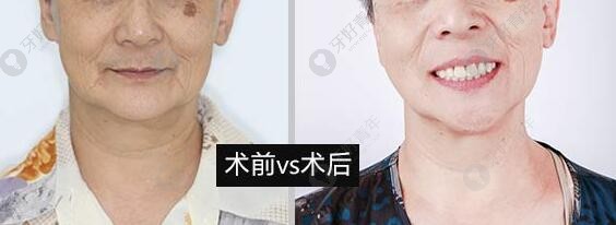 70岁老人在北京海德堡联合口腔做全口牙种植牙前后对比