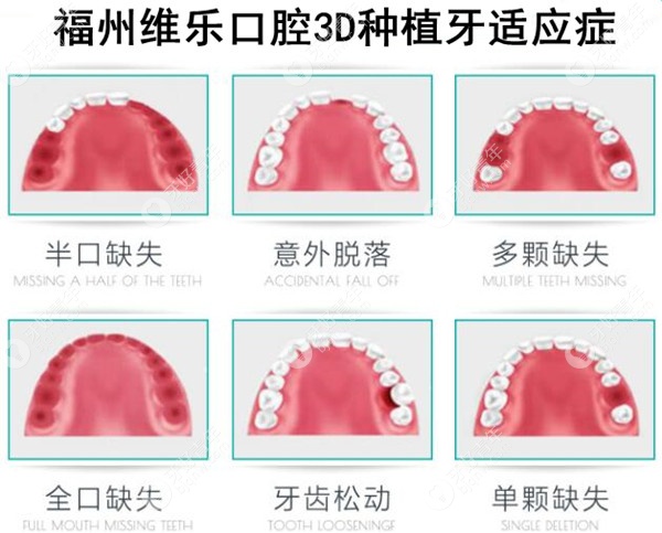 福州维乐口腔3D种植牙适应症