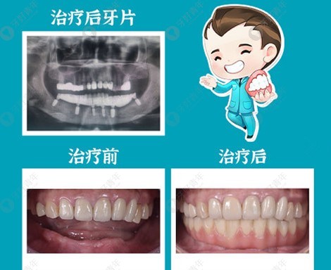 在深圳做登腾半口6颗种植牙的价格和效果都很赞,有图为证