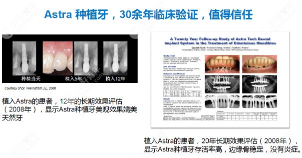 Astra种植牙有30多年的临床经验