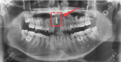 在西安诺贝尔口腔做种植牙后的CT片