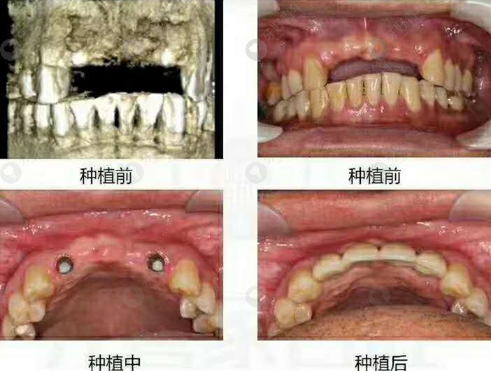 连着四颗牙缺失不用全种牙,做2颗奥齿泰TSⅢ种植体就好
