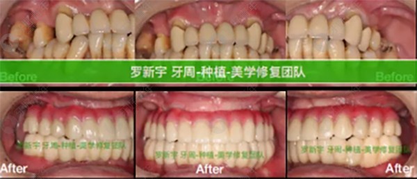 重度牙周炎也可以用士卓曼BLT种植体做全口即刻负重种植