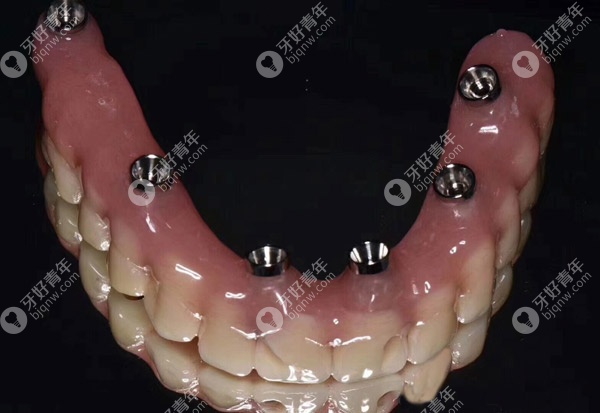 全口的临时假牙