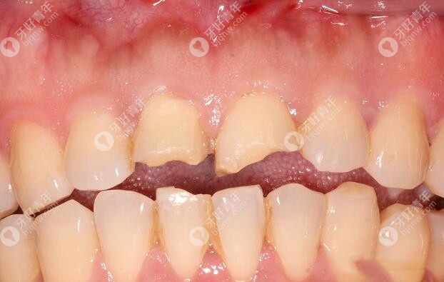 前牙牙体折裂