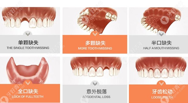 8种牙齿缺失情况需要种植牙