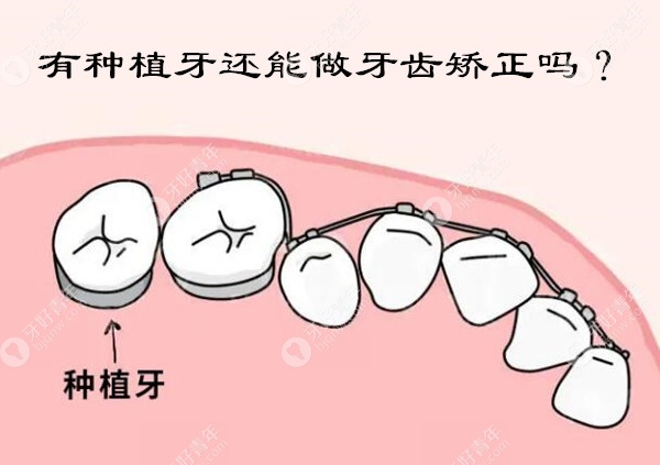 做了种植牙还能做牙齿矫正吗