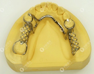纯钛活动义齿能用几年