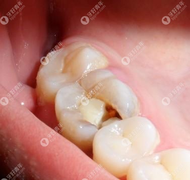 牙齿矫正期间蛀牙能治疗