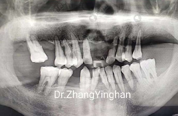 全口即拔即种的经历:重度牙周炎的老汉儿做了满口种植牙