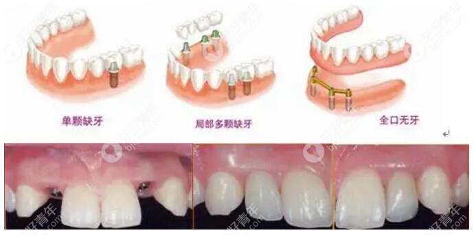 快可以当天种牙、当天戴牙当天用