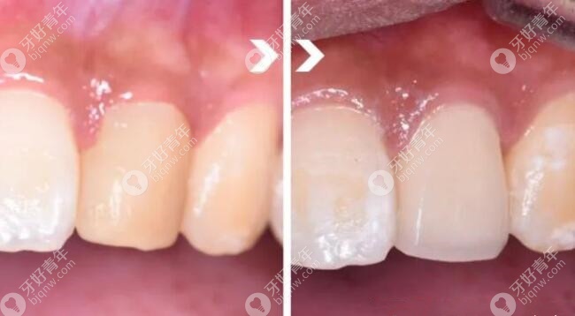 牙齿修复前后对比图