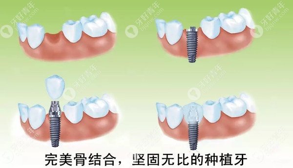 种植牙和真牙一样坚固耐用吗