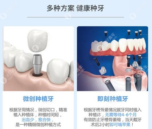 杭州亮贝美口腔种植牙技术优势