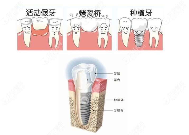 种植牙和固定搭桥牙哪个好?看完镶牙和种牙的区别你就知道