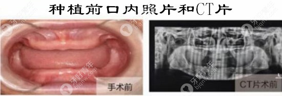杭州亮贝美口腔ALL-ON-4满口种植牙案例