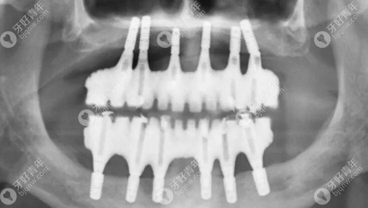 种植牙口内X线片