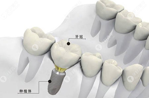 牙齿缺失种牙是理想的修复方式