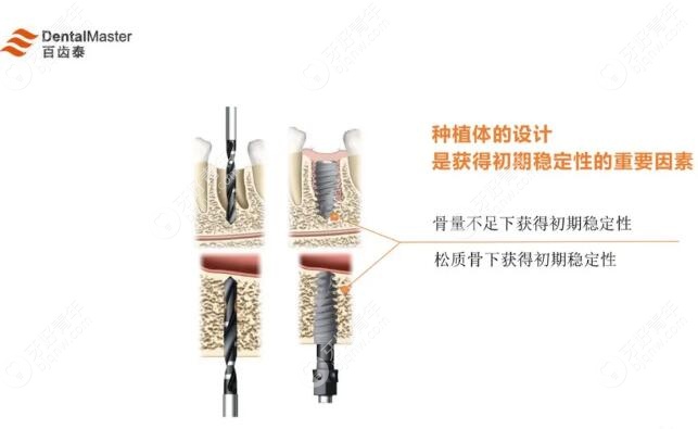 百齿泰种植牙的表面处理