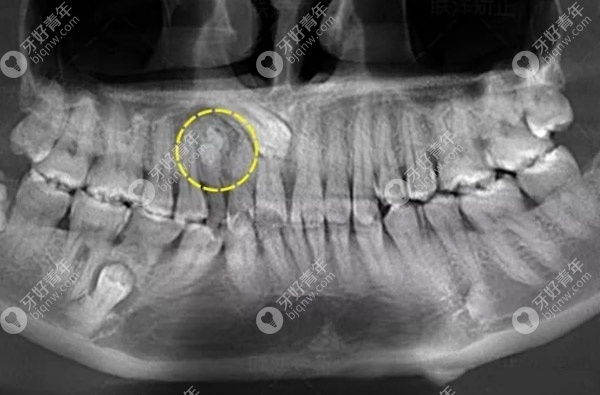 牙科X光辐射危害巨大是谣言不可信