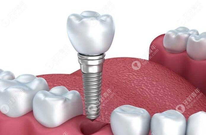 意大利种植体的型号种类比较多