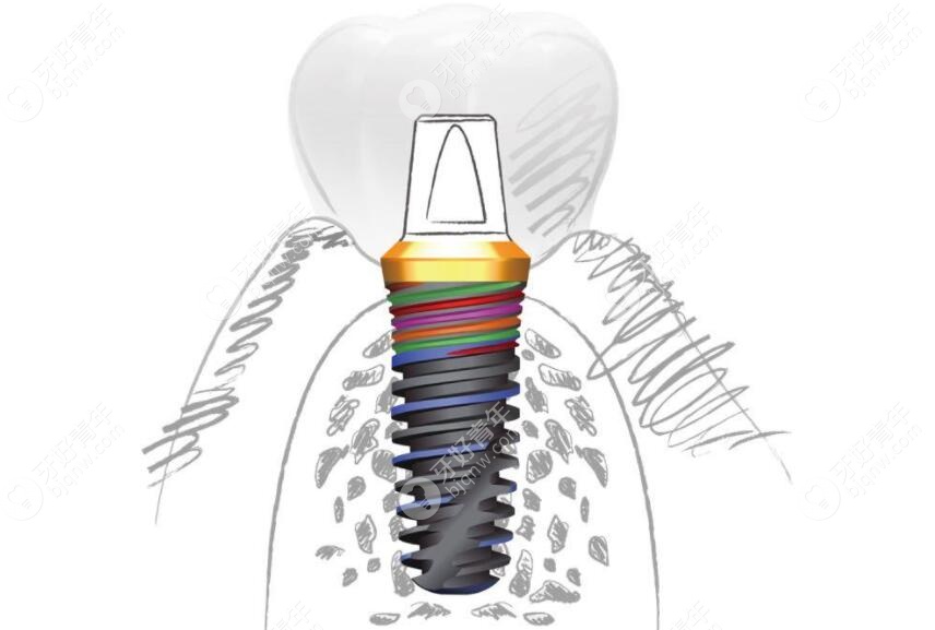 种植牙中德国和意大利品牌哪个好?比如BB和ICX植体有啥区别