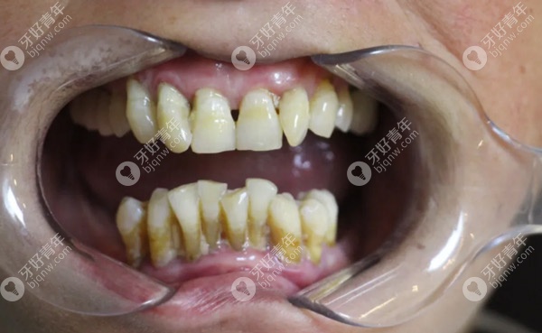 治疗前牙齿的情况，重度牙龈萎缩