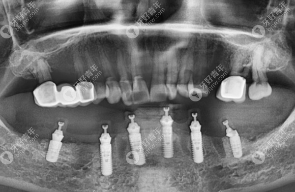 6颗瑞士strauman种植系统已植入牙齿中