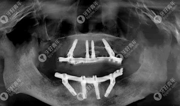 长沙优伢仕口腔全口种植牙术后CT片