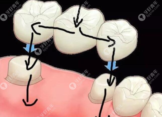缺一补三颗牙牙冠示例图