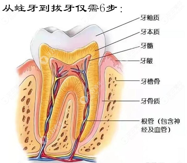 从蛀牙到拔牙的过程仅需6步