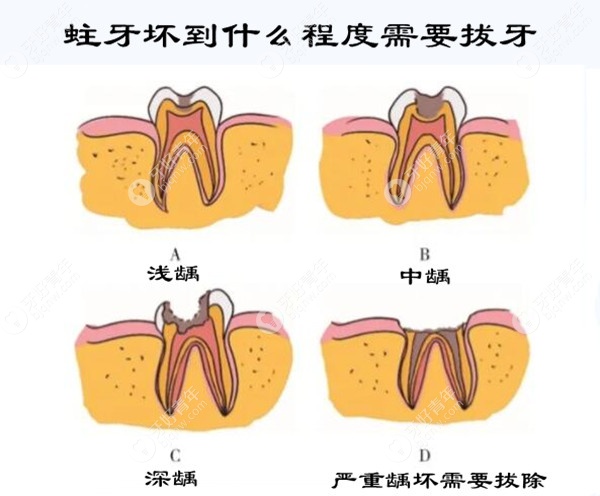蛀牙坏到什么程度需要拔牙