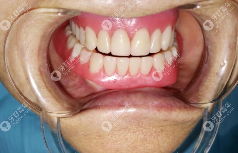 牙齿咬合重建的适应时间要多长?重建后达到的效果还不错哦