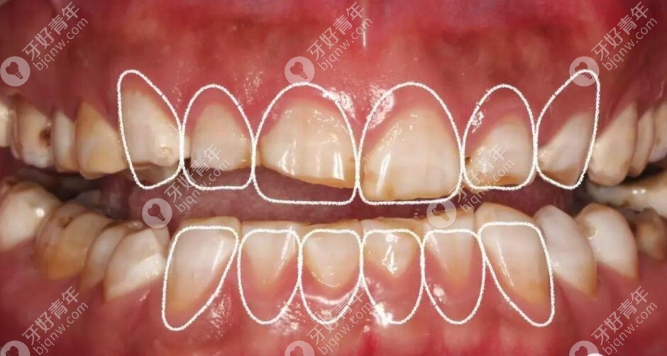 牙齿咬合重建的适应时间要多长?重建后达到的效果还不错哦