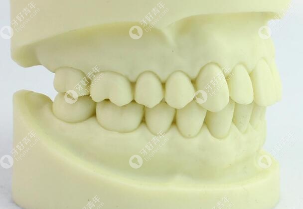 正常咬合的模型图片