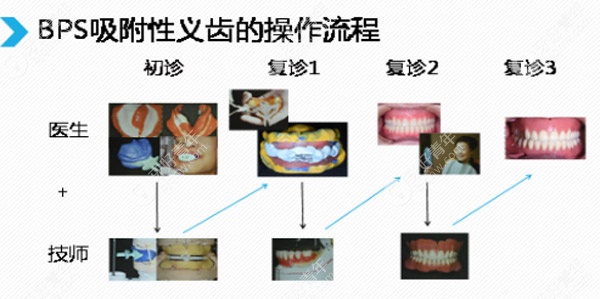 撇开优缺点不谈,就说BPS全口吸附性义齿的价格贵吗