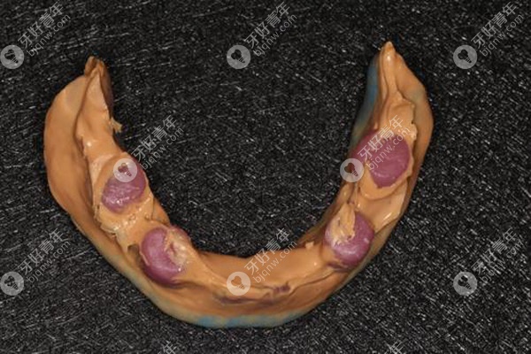 撇开优缺点不谈,就说BPS全口吸附性义齿的价格贵吗