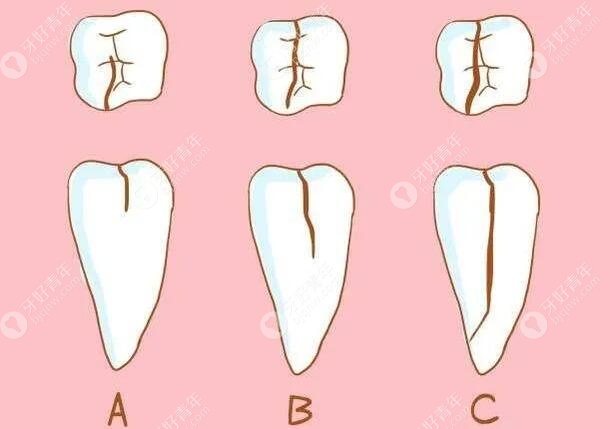 牙齿各种隐裂程度示意图