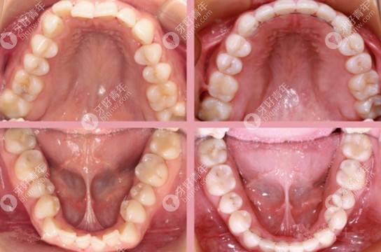 牙弓产生的变化