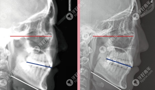 颌骨CT显示