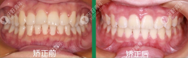 只拔智齿的推磨牙矫正成功了 只拔智齿的推磨牙矫正成功了