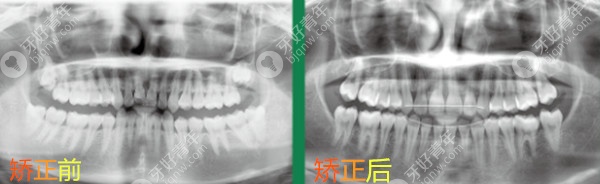 整牙可以改善上唇嘴突吗？22岁的我通过后推磨牙矫正做到了