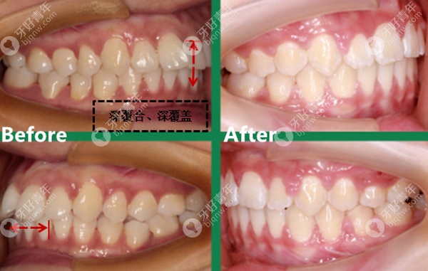 整牙可以改善上唇嘴突吗？22岁的我通过后推磨牙矫正做到了