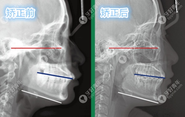 低下巴不后缩的推磨牙成功案例 低下巴不后缩的推磨牙成功案例